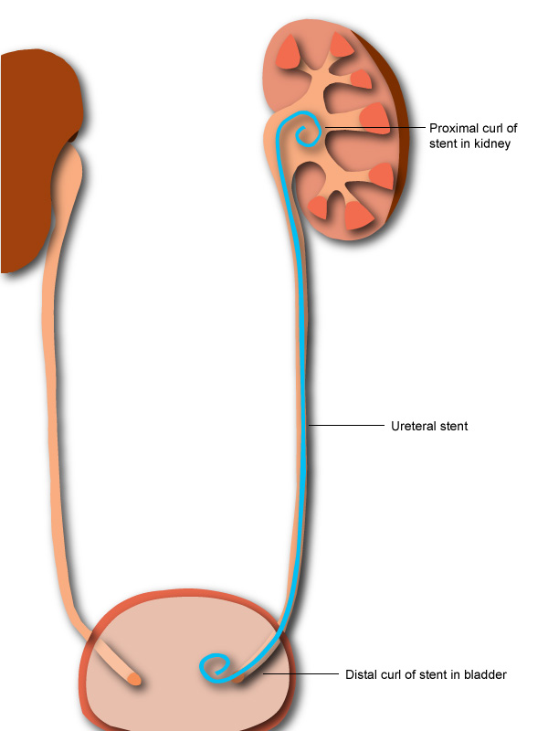 How is a ureteric stent put into place?