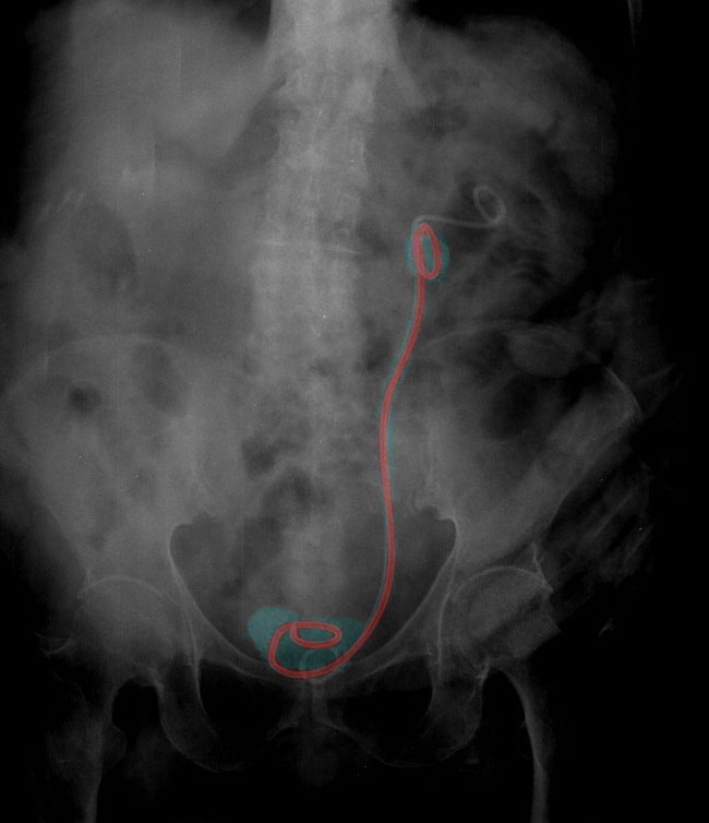 What is the recovery time after a ureteral stent?