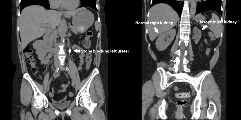 Why do kidney stones cause pain?