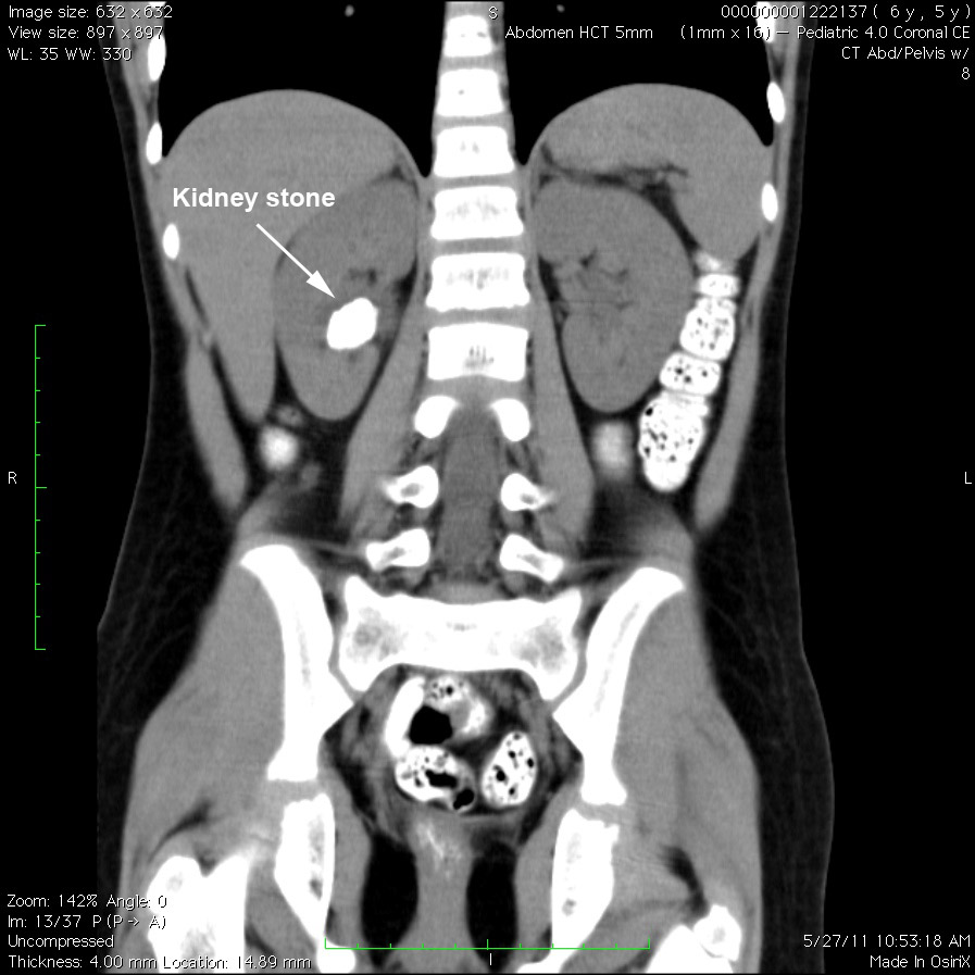 Kidney stones in children - KidneyStoners.org stone crab