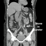 Media related to kidney stones