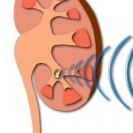 Treatment options for kidney stones
