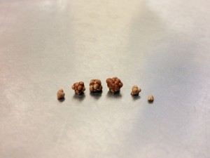small-kidney-stones