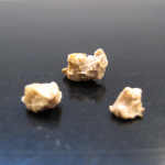 Picture of kidney stones