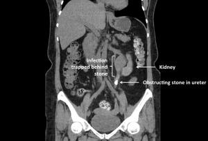 Obstructing ureteral stone and infection