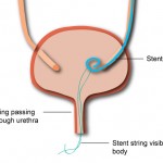 How is a ureteral stent removed?