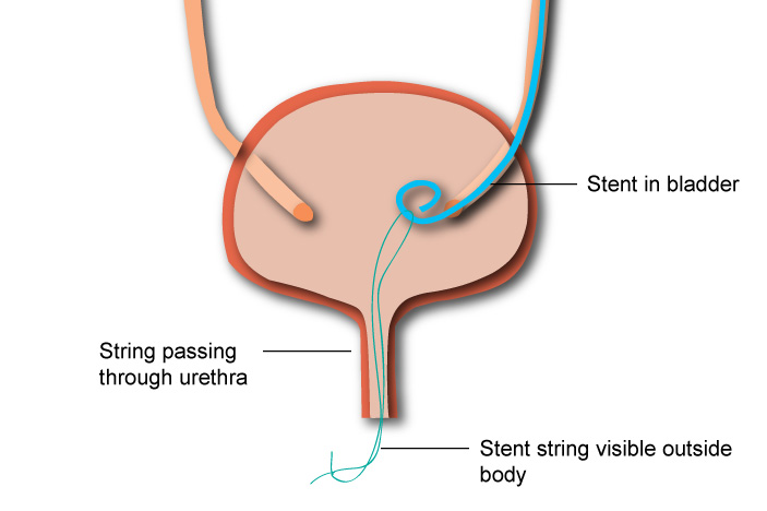 pénisz stent
