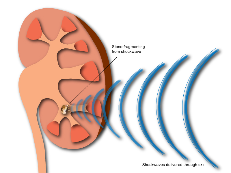 Videos and illustrations of kidney stones 