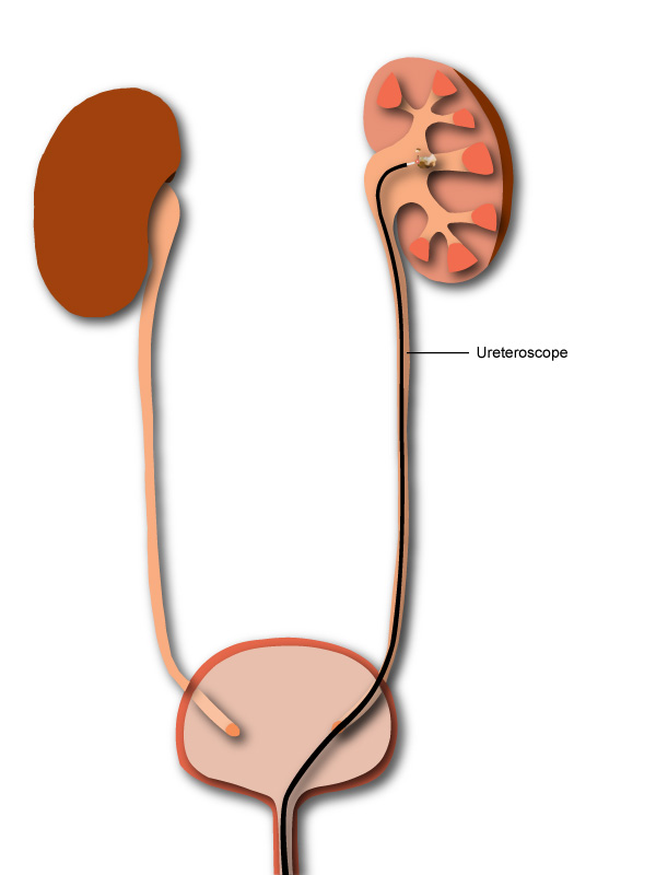 Diagram of ureteroscope in kidney