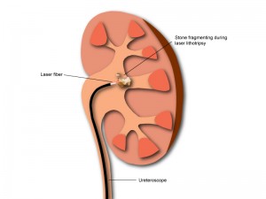 Diagram of laser lithotripsy