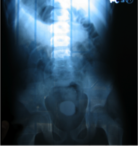 bladder stone in a child