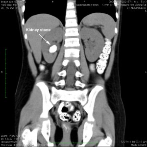 CT scan of a five year old with a right kidney stone
