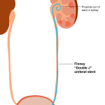 Finney double j stent illustration