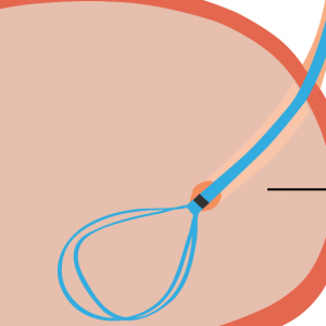 looped stent closeup