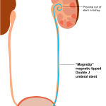 magnetip ureteral stent illustration