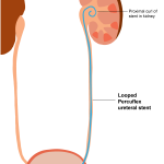 percuflex looped stent illustration