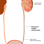 resonance stent illustration