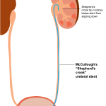 shepherds crook stent illustration