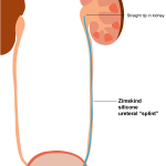 zimskind ureteral stent illustration