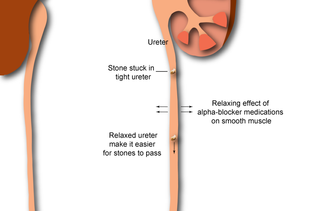 Lorazepam And Kidney Stones