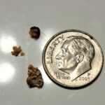 Kidney stones passed by a 50 year-old man in Greensboro, MD on July 23, 2025.